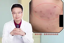 为什么长痘吃多西环素、米诺环素吃了有效停了复发？#皮肤科医生谢红付  #红付教授说敏痘  #痤疮  #痘痘  #手把手让你更健康  @谢红付聊敏痘