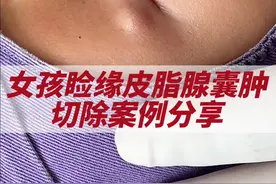 小姑娘睑缘皮脂腺囊肿手术切除案例分享！#医学科普 #变美 #手术 #皮脂腺囊肿视频封面