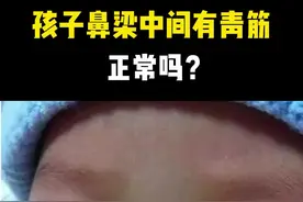 孩子鼻梁中间有青筋，正常吗#育儿经验分享 #健康科普 #脾胃视频封面