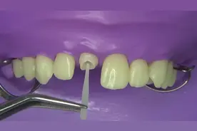 打桩（纤维桩）