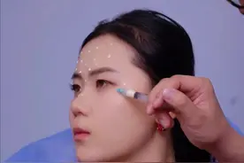 一支肉毒素搞定全脸除皱提升 #肉毒素 #除皱针 #面部提升 #变美