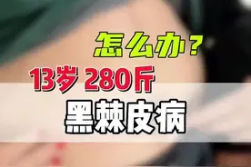 1米83的13岁小孩儿#黑棘皮 #儿童肥胖 #袖状胃 #减重手术 #医学减重刘少壮