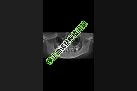 利用停止曲配合牵引钩可以很好的控制6-6的所有间隙 #正畸 #牙齿矫正 #整牙历程 #口腔 #牙套日记