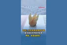 罕见！女生拔智齿现四牙根，医生直言可作医学标本，网友：好茁壮的牙！来源：#小羊拍客 （[原创]记者：朱艾婷；编辑：潘俊华 ；实习生：陈宾杏；审签：罗钧栋）#牙齿 #智齿 #牙医视频封面