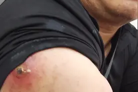 沉浸式挤脓！！！视频封面