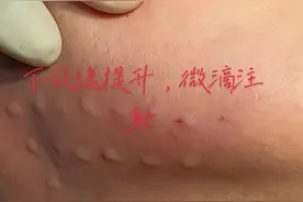 整形常规，肉毒素注射提升下颌缘或者做瘦脸针后的担心皮肤下垂的反向补充#肉毒 #下颌缘提升 #微滴注射
