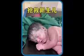 新生儿被羊水呛得无法呼吸，刚出生下两分钟就面色发白