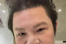 谁有我的头秃！你看看这效果#理然 #拯救发际线 #男生头顶头发稀少怎么办