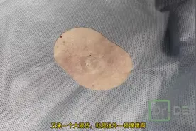 大脓包#挤痘痘 #重口味 #引人不适请谨慎观看 #视觉冲击 #解压