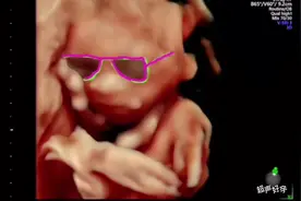 #孕18周 超声讲解全过程，祝孕妈们孕期一路绿灯