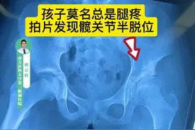 大龄髋关节半脱位 10岁的孩子总是腿痛，越来越厉害，大腿根疼痛、大腿中下段疼痛，一直以为是#滑膜炎 来医院拍摄骨盆正位X光片，发现髋关节半脱位，髋臼与股骨头匹配差，反复腿疼莫轻视，要做相应检查排查一些少见情况