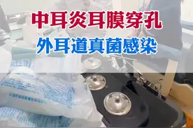 中耳炎耳膜穿孔，外耳道真菌感染怎么治疗？#中耳炎 #耳膜穿孔 #中耳炎鼓膜穿孔 #外耳道真菌感染 #耳鼻喉刘军