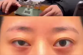 神奇的“跷跷板”眼睛——大小眼“赫林现象”#医学科普 #上睑下垂 #双眼皮 #大小眼 #上睑下垂视频封面