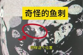 奇怪的鱼刺，吃鱼要小心鱼刺