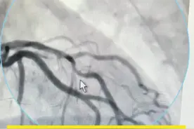 这种情况可以暂时先保守治疗#支架 #支架手术 #心血管 #心内科 #冠心病