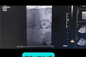 超声征象 超声征象。#医学科普 #超声影像 #超声学习 #医学小知识 #超声医学 @抖音短视频视频封面