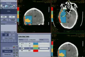 【CT后处理2】脑出血测量