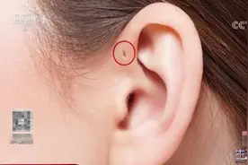 耳朵旁边有“小眼”，当心耳前瘘管感染，该咋预防？|生活圈0115视频封面