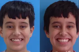 实拍！12岁男孩因小虎牙自卑，戴了牙套后颜值变化如此之大！