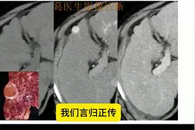 肝癌用CT平扫查？不是不行，不是很行 20241006 有些肝癌